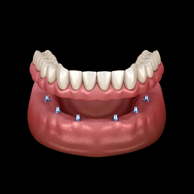 Snap-in dentures secured with dental implants