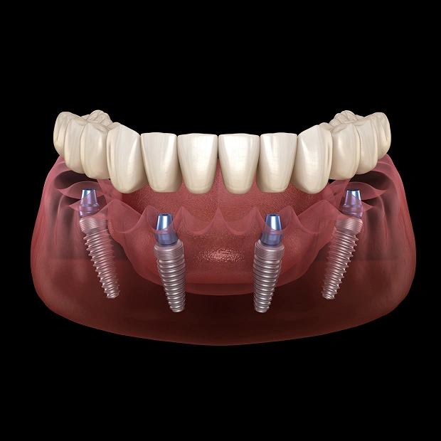 All-on-4 dental implant restoration