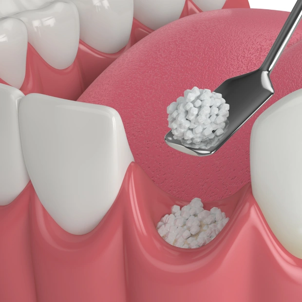 Dental bone grafting procedure illustration