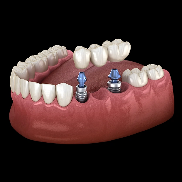 Implant-supported bridge replacing multiple missing teeth
