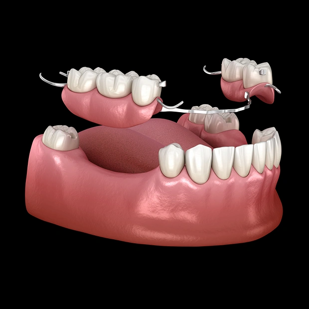 Partial dentures replacing missing teeth