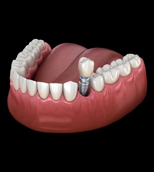Single tooth dental implant restoration
